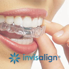 invisalign_braces